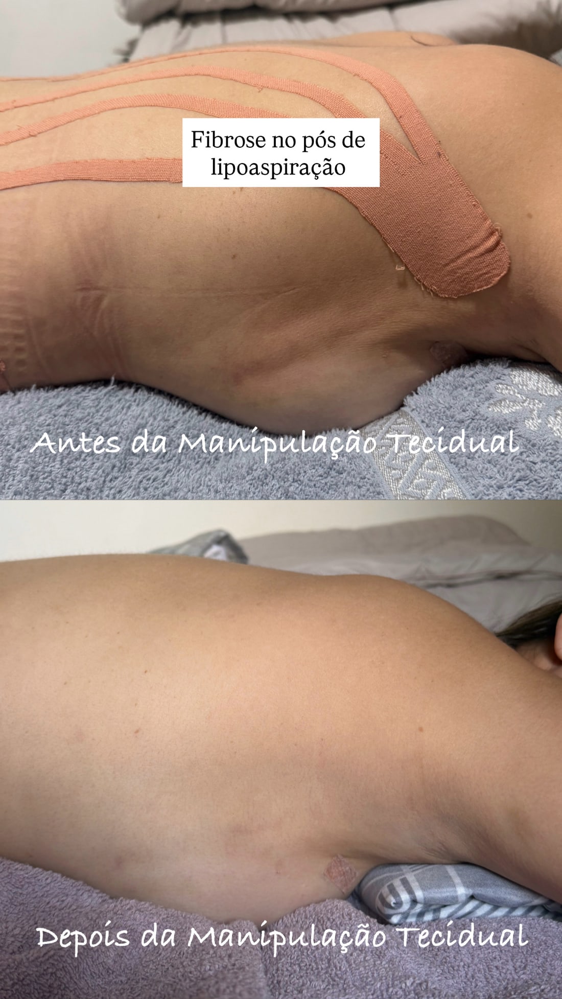 Fibrose no pós de lipoaspiração — antes e depois da manipulação tecidual