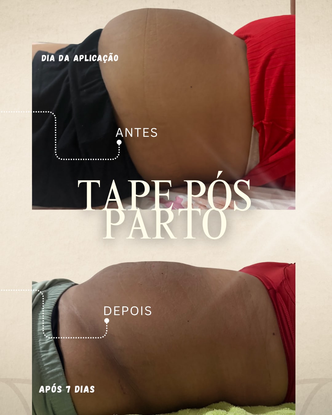 Tape pós-parto — antes e após 7 dias